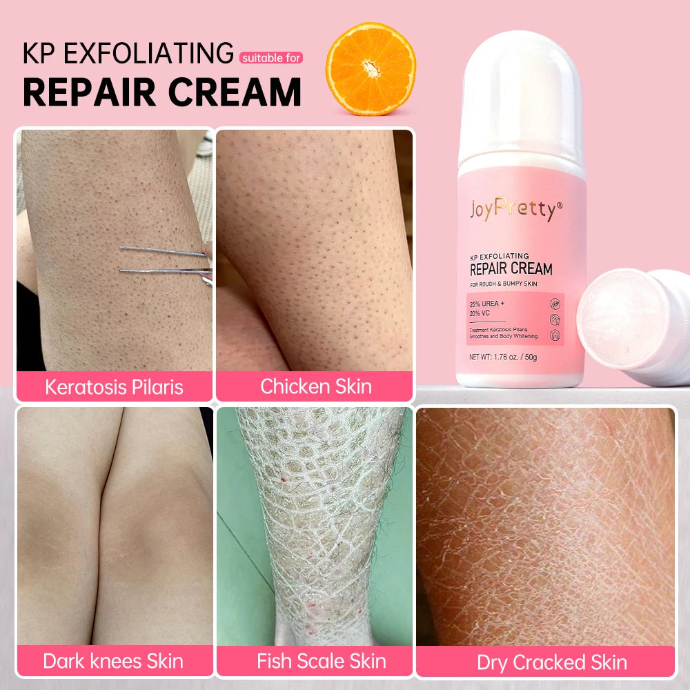 Body Cream Chicken Skin Removal Treatment Keratosis Pilaris Lotion Rough Bumpy Pore Spots Care Moisturizer Whitening Creams 60g  beautylum.com   