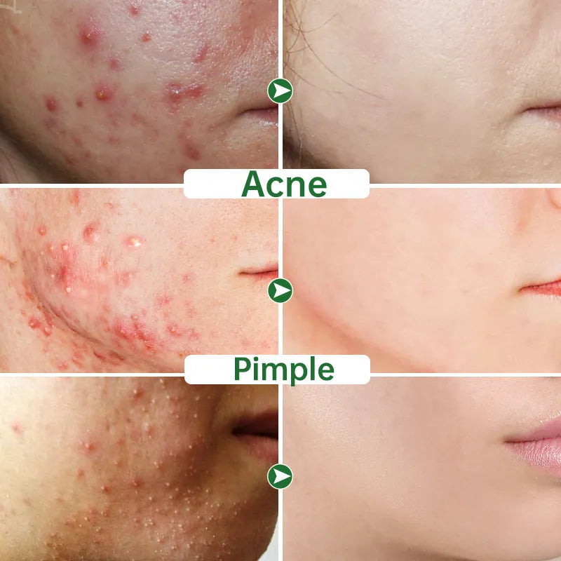 ClearSkin Herbal Acne Cream: Plant-Powered Skin Solution