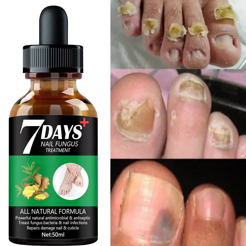 7DAYS Nail Fungus Treatment Essence Serum Care Hand and Foot Care Removal Repair Gel Anti-infective  beautylum.com   
