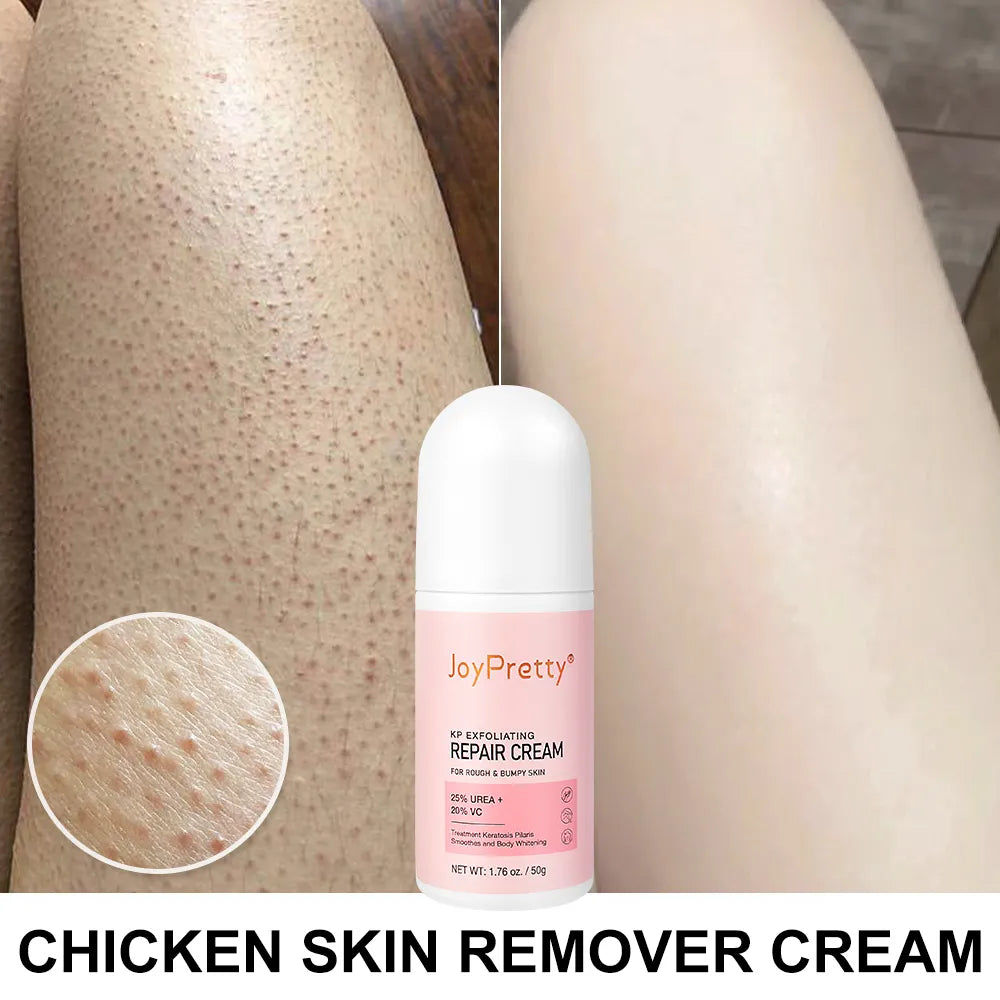 Body Cream Chicken Skin Removal Treatment Keratosis Pilaris Lotion Rough Bumpy Pore Spots Care Moisturizer Whitening Creams 60g  beautylum.com CHINA  